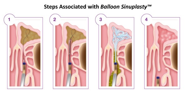 balloon sinuplasty